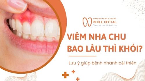 Viêm nha chu bao lâu thì khỏi? Lưu ý để bệnh nhanh cải thiện
