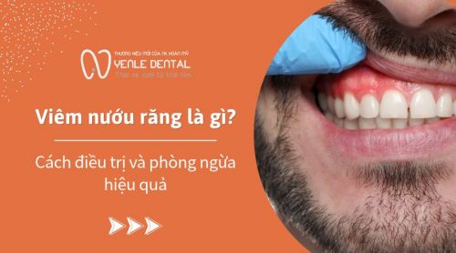 Viêm nướu răng là gì? Cách điều trị và phòng ngừa hiệu quả