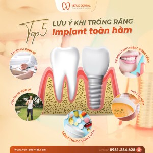 Top5 Lưu ý khi trồng răng implant toàn hàm