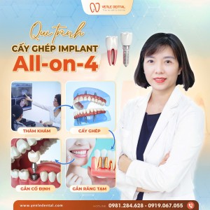 Quy trình cấy ghép implant All-on-4