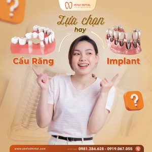 Cầu Răng So Với Implant - Phương Pháp Nào Phù Hợp Hơn?