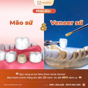 Phân biệt mão sứ và veneer sứ