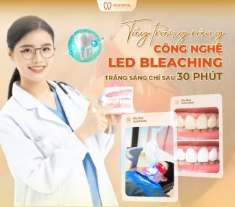 tẩy trắng răng chỉ sau 30 phút