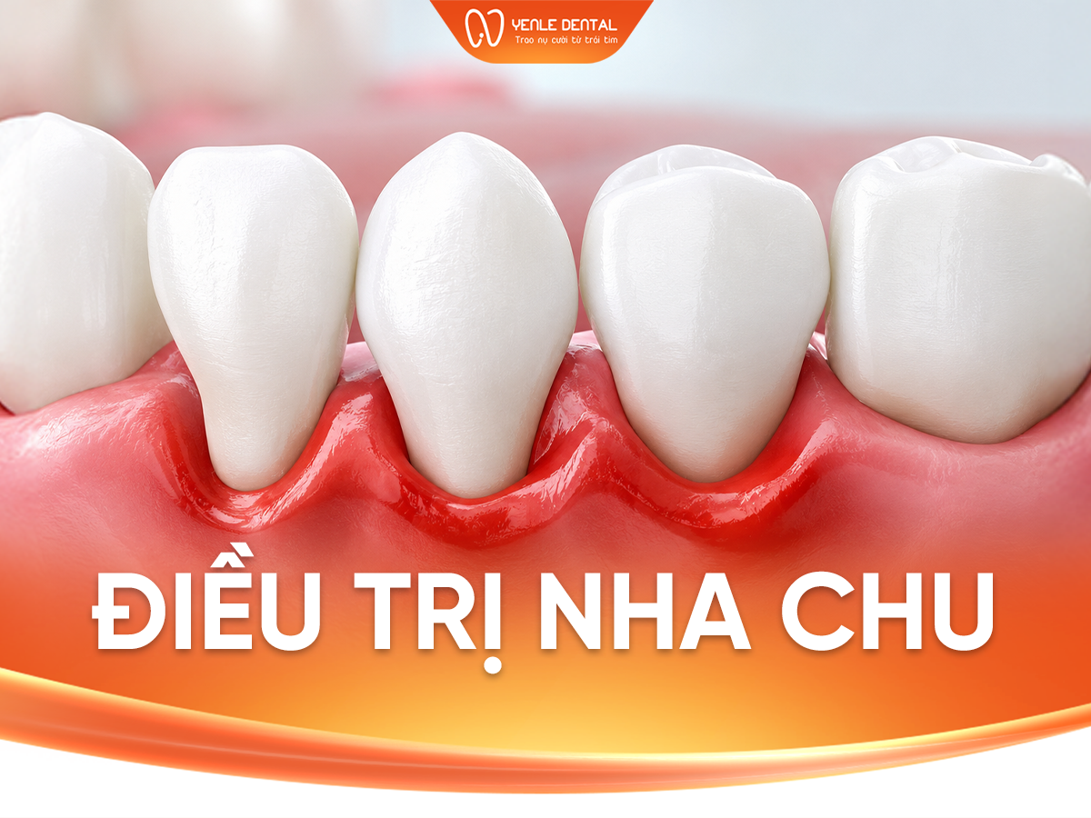 Điều trị nha chu