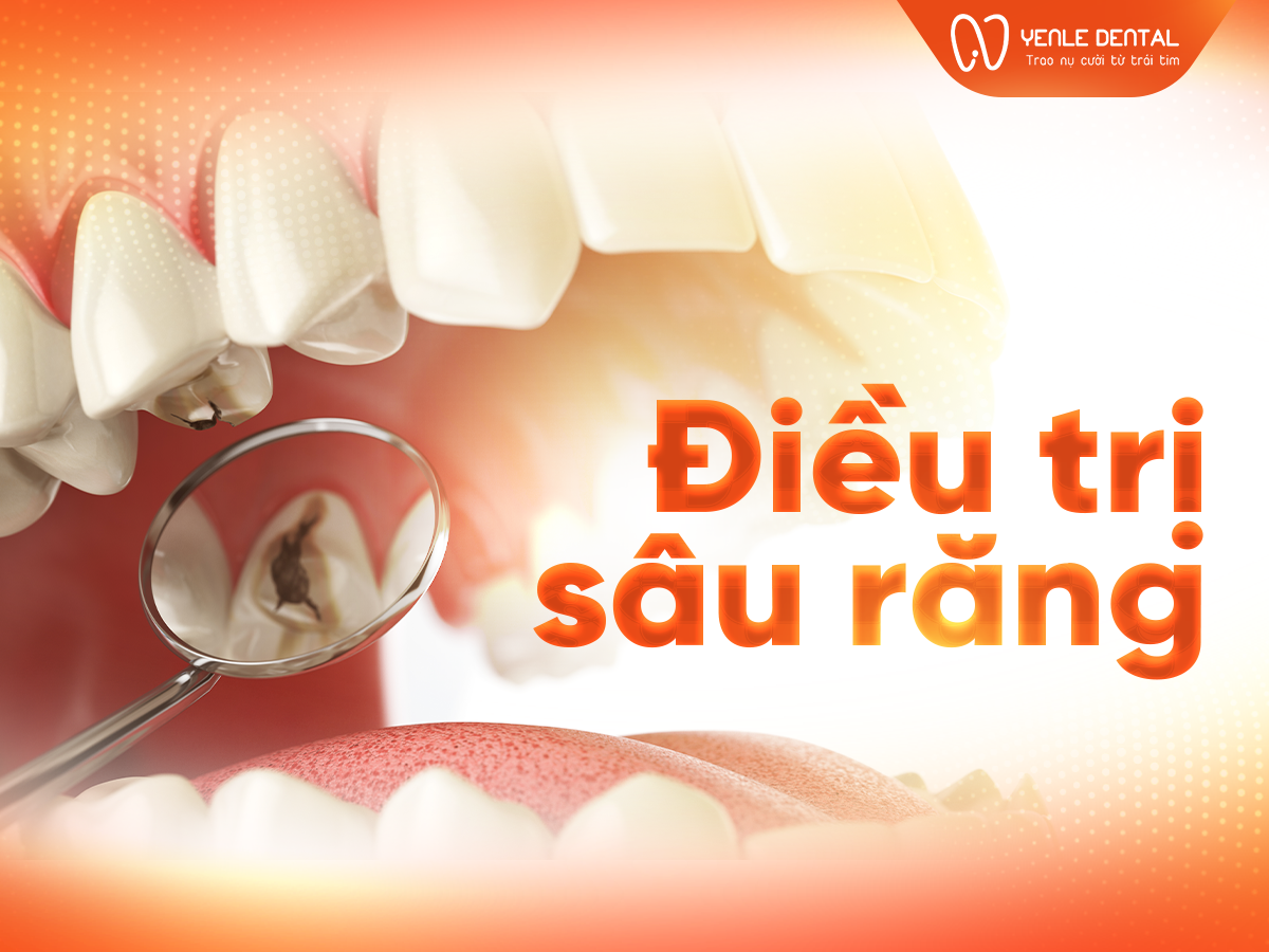 Điều trị sâu răng